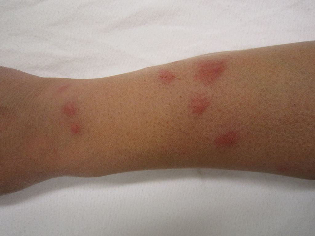 human hand bed bug rush